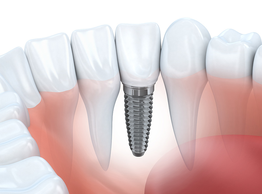 Implant Supported Crown And Bridge Jacksonville