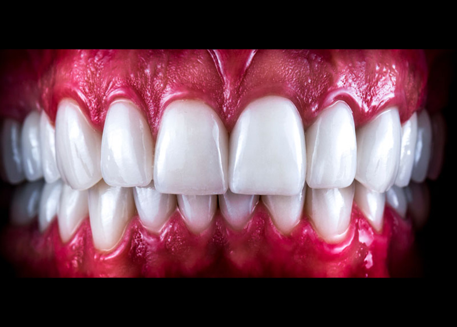 Full Mouth Dental Implants Jacksonville Florida