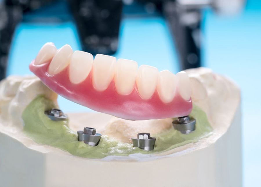 Implant Supported Dentures Dentist Jacksonville Florida