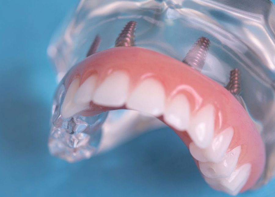 Implant Supported Dentures Jacksonville Florida Dentist